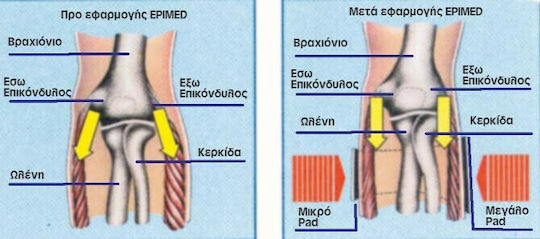 Ortholand Epi Med W/ Silicone Περιαγκωνίδα σε Λευκό χρώμα