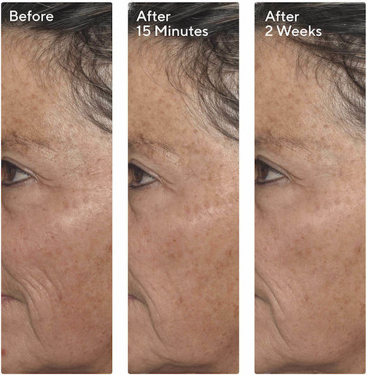 Murad Targeted Wrinkle Corrector Αντιγηραντική Κρέμα Προσώπου Ημέρας με Υαλουρονικό Οξύ & Πεπτίδια 15ml