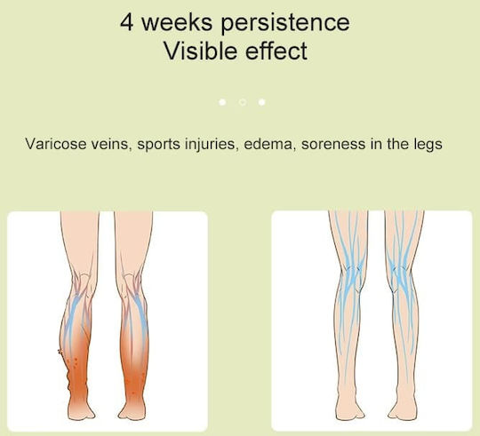 Lymphedema Device for Lower Limb