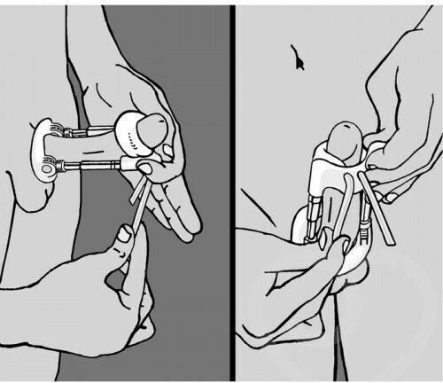 Chisa Novelties Penis Enlarger Pro Extender System Μεγεθυντής Έλξης Πέους Λευκός