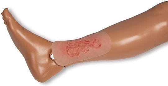 Kleines venöses Beingeschwür Wunde Phase Epithelisierung Erler Zimmer