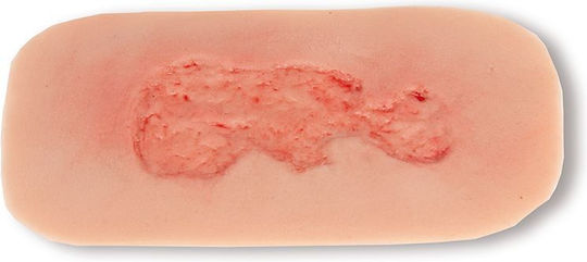 Kleines venöses Beingeschwür Wunde Phase Epithelisierung Erler Zimmer