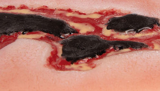 Small Arterial Ulcer Leg Wound Exudation Phase Erler Zimmer