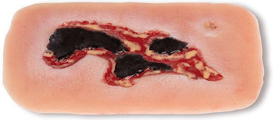 Small Arterial Ulcer Leg Wound Exudation Phase Erler Zimmer