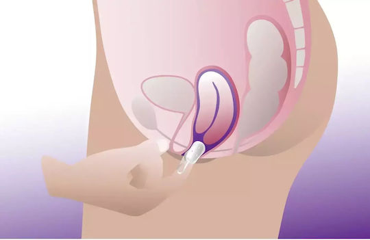 ProFem Vaginal-Pessar Cube Pessary ohne Οπές Ohne Löcher