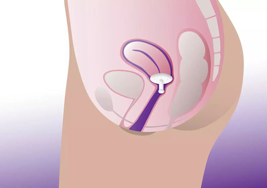Pesar vaginal Gellhorn cu tijă lungă Profem