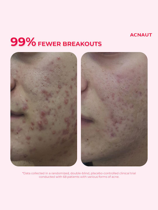 Biotrade ACNAUT Trial Kit with Oxy Wash 50ml + Active Lotion 20ml + Hydro Active 20ml Σετ Περιποίησης για Ενυδάτωση & Κατά της Ακμής Biotrade ACNAUT Trial Kit with Oxy Wash 50ml + Active Lotion 20ml + Hydro Active 20ml Σετ Περιποίησης για Ενυδάτωση & Κατά της Ακμής