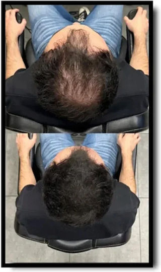 Hair Thinning Coverage Batci Hair Concealer Filling