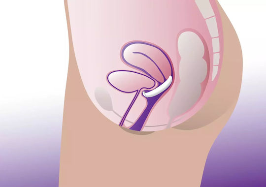 ProFem Pessarul vaginal Dish Pessary membrană de susținere