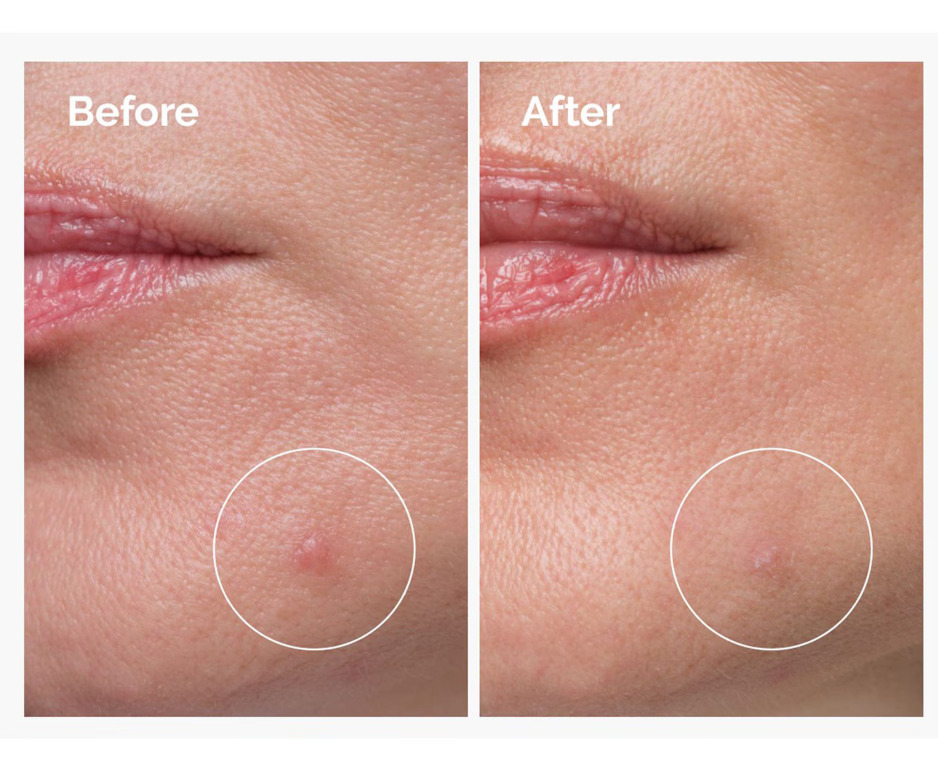 The Ordinary Sulfur 10% Powder to Cream Κρέμα Προσώπου κατά των Ατελειών & της Ακμής 5gr