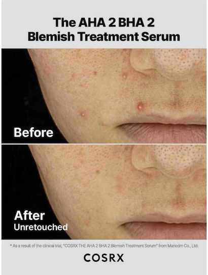 Cosrx The AHA 2 BHA 2 Blemish Treatment Soothing & Moisturizing Serum Face with Hyaluronic Acid for Detoxification & Dark Spots 50gr