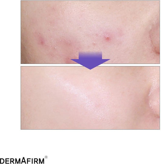 Dermafirm CICA A.C Soothing Serum Face with Bakuchiol for Acne 30ml