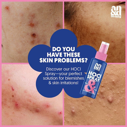 AndBeauty Hocl Spray for Acne & Eczema 30ml