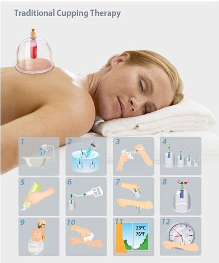 Set of 18 Traditional Therapy Suction Cups