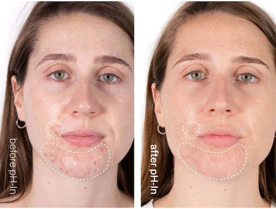 Set rutină de îngrijire pentru piele sensibilă predispusă la acnee în 3 pași Ph-in Healthy Skin System Indeed Labs 3 articole