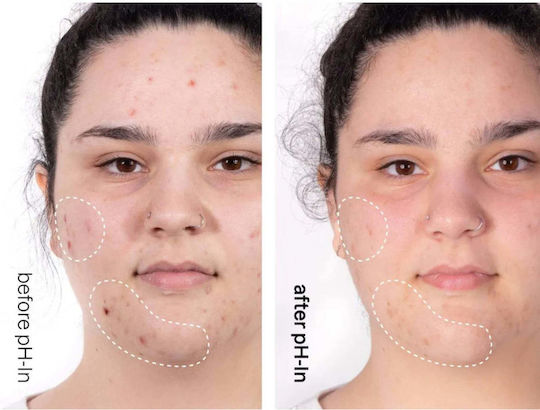 Set rutină de îngrijire pentru piele sensibilă predispusă la acnee în 3 pași Ph-in Healthy Skin System Indeed Labs 3 articole