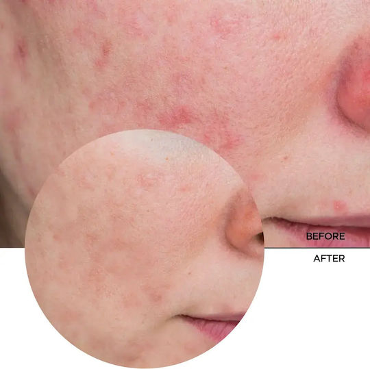 Revox Just Azelaic Acid 10% Gel Face Day 30ml